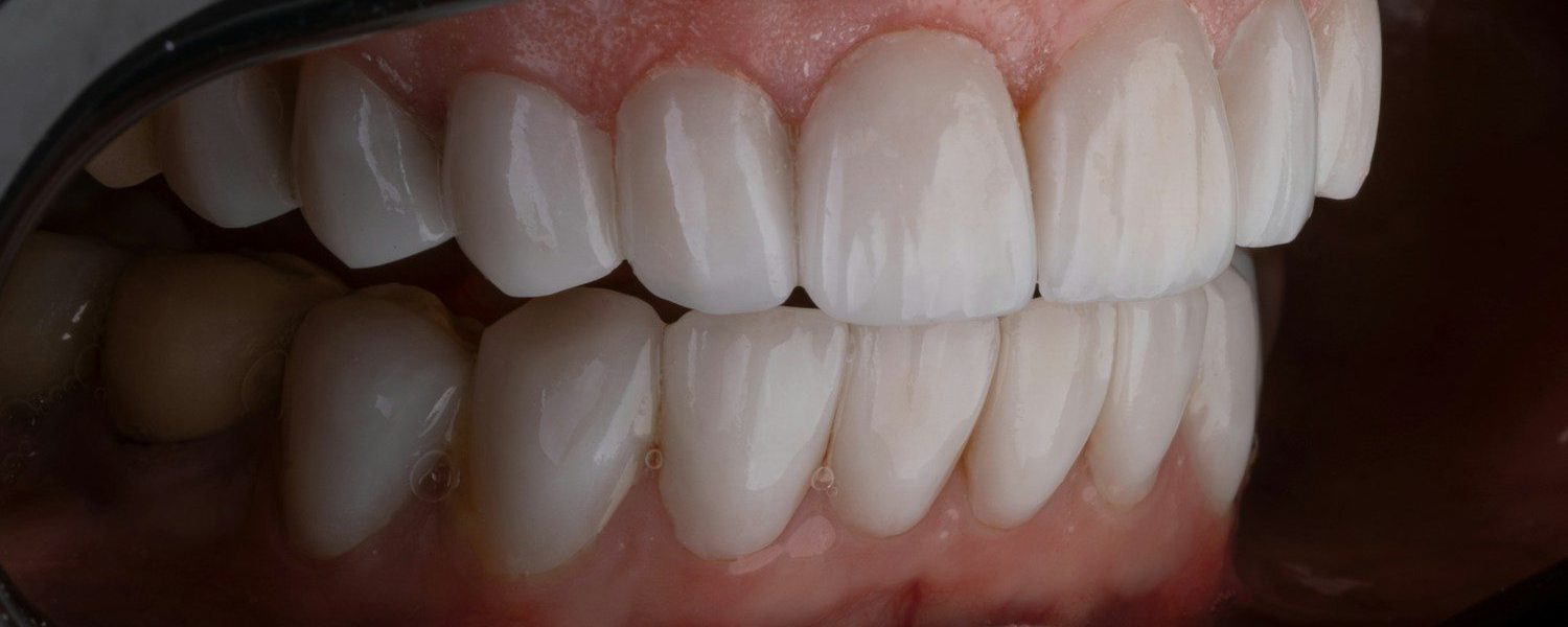 a person's mouth with teeth