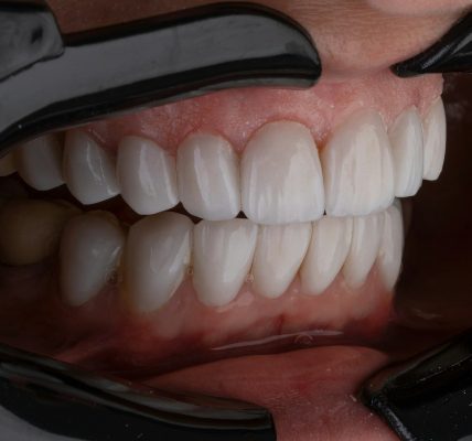 a person's mouth with teeth