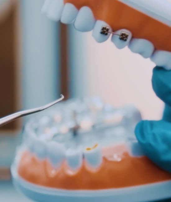 tooth decay