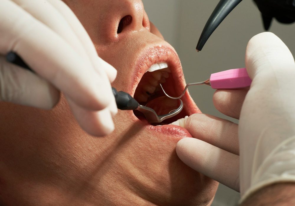 dental filling