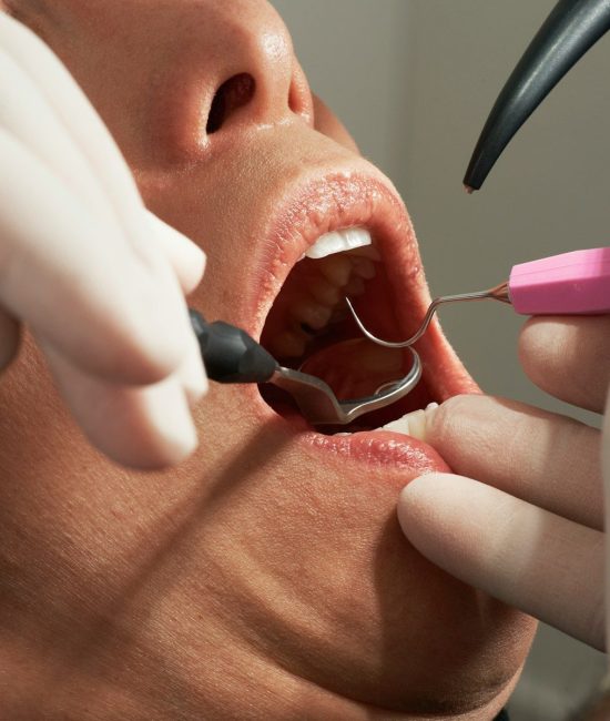 dental filling